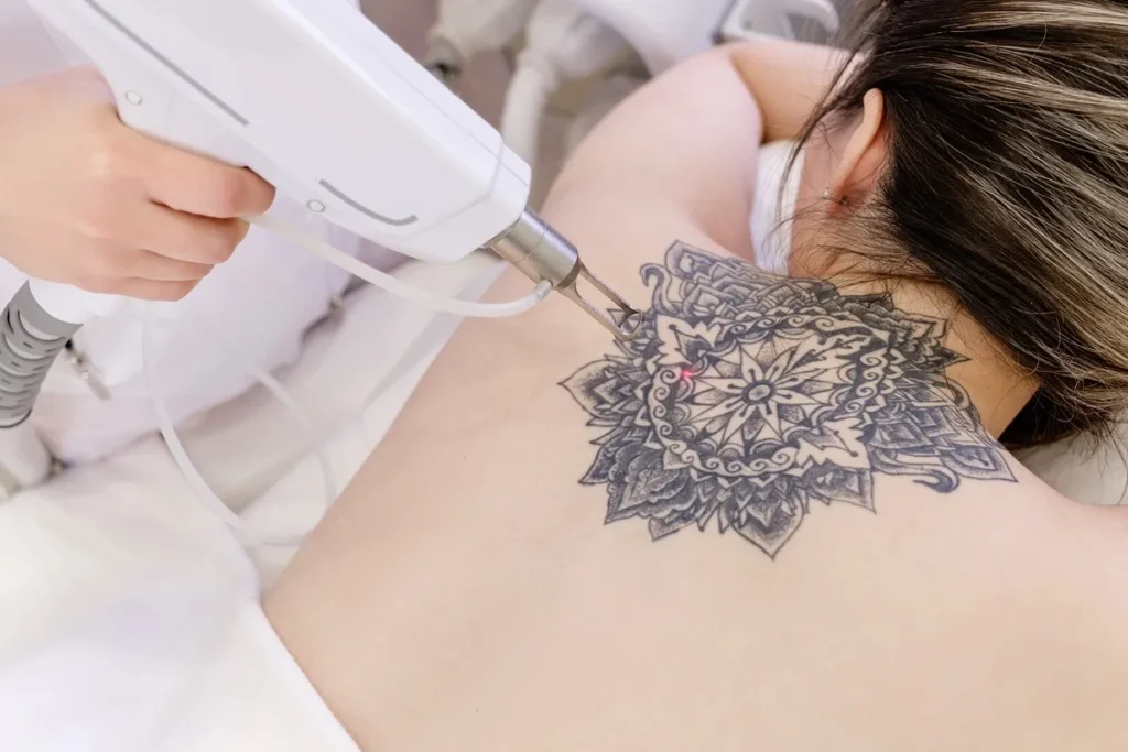 tattoo-removal-at-ella-esthetics-in-alexandria-va