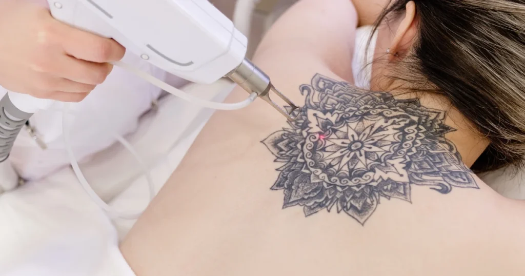 laser tattoo removal procedure on a woman's back in Alexandria, VA