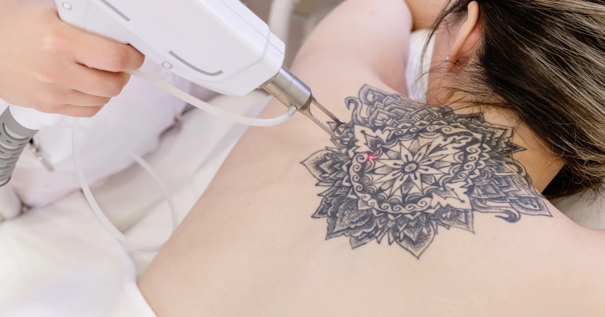 laser tattoo removal procedure on a woman's back in Alexandria, VA